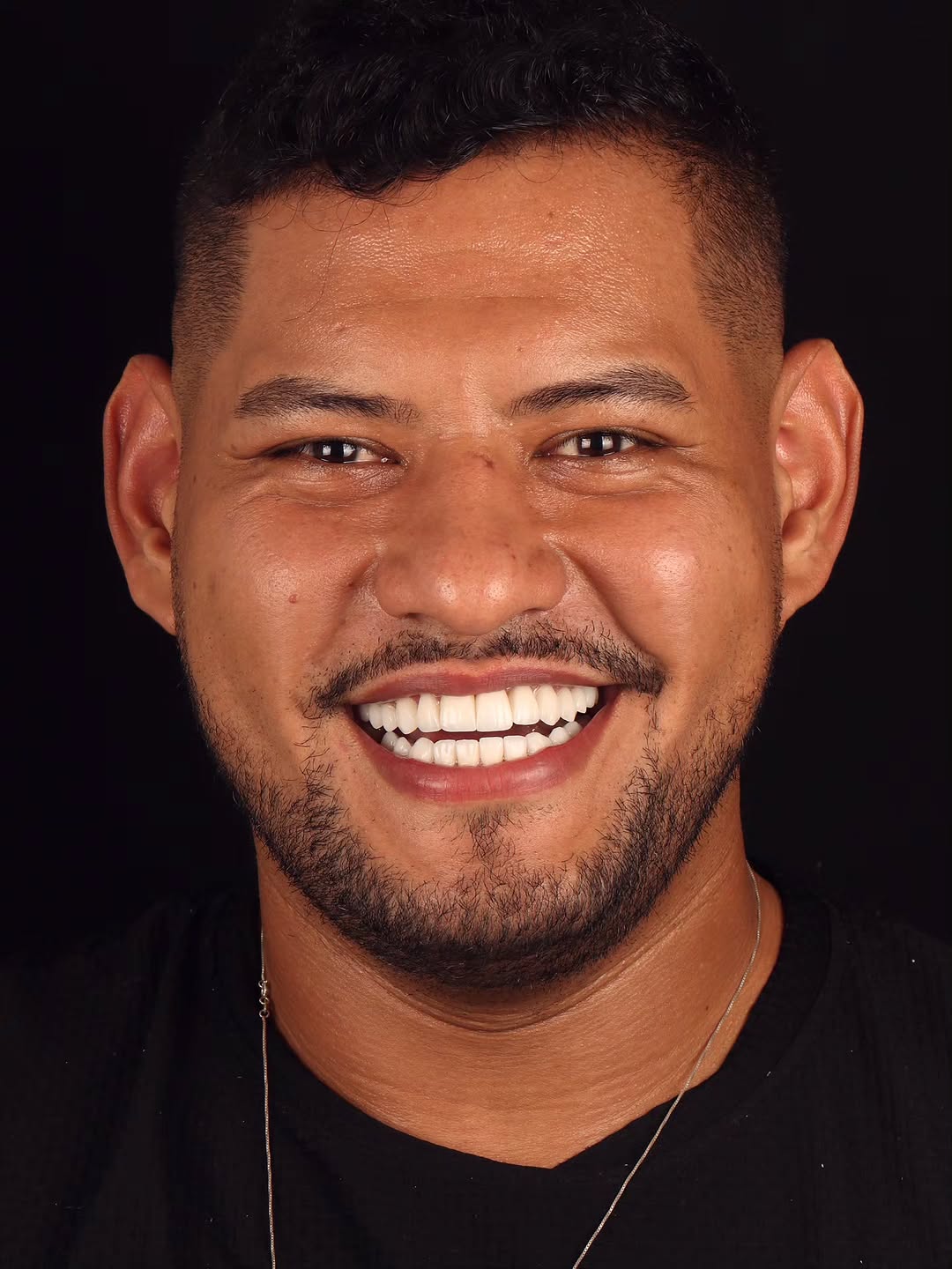 Sorriso masculino reabilitado