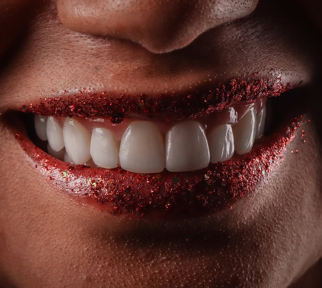 Sorriso transformado com lentes em resina